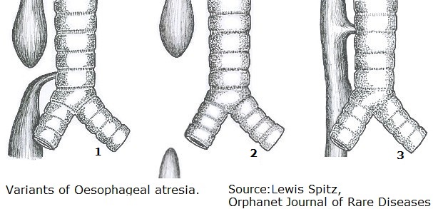 Øsofagusatresi - NHI.no