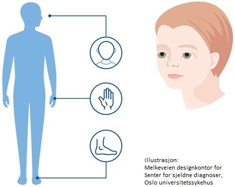 Aarskog syndrom innebærer en forsinket lengdevekst og kan gi karakteristiske kjennetegn i ansikt, på hender, føtter og kjønnsorgan. Aarskog syndrom