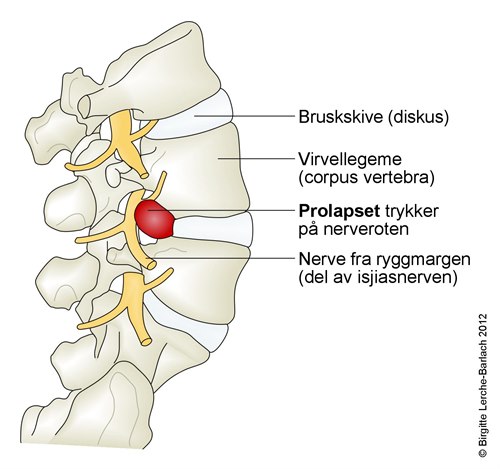 Skiveprolaps