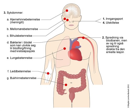 Sykdommer som kan være forårsaket av pneumokokker Sykdommer som kan være forårsaket av pneumokokker