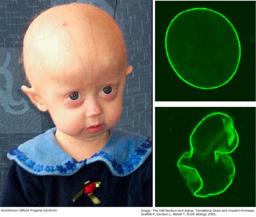 Progeria Progeria
