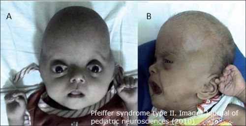 Pfeiffer_s syndrome type II.jpg
