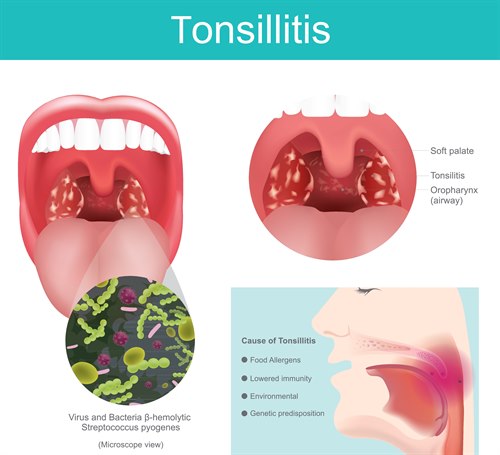 Tonsillitt.jpg Tonsillitt.jpg